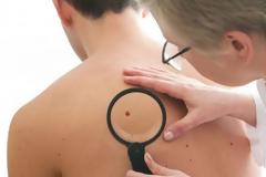 Όλα όσα πρέπει να ξέρετε για τις κόκκινες ελιές στο δέρμα