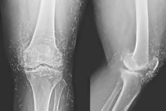 Πήγε στο γιατρό επειδή πονούσαν τα γόνατά της και οι γιατροί έπαθαν σοκ με αυτό που αντίκρισαν...