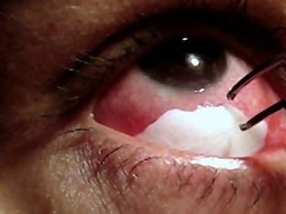 Φωτογραφία για ΑΠΙΣΤΕΥΤΟ: Η Βραζιλιάνα με τα κρυστάλλινα δάκρυα - Μια σπάνια ασθένεια [photos]