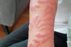 Έτσι κατέληξαν δυο παιδιά που έκαναν τατουάζ henna -Tι λένε οι ειδικοί