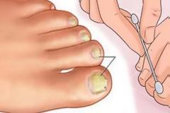 Έχετε μύκητες στα πόδια; Δείτε πως θα τους εξαφανίσετε...