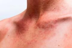 Παθαίνετε συχνά ηλιακό έγκαυμα; Μπορεί να είναι δηλητηρίαση από τον ήλιο - Συμπτώματα και αντιμετώπιση