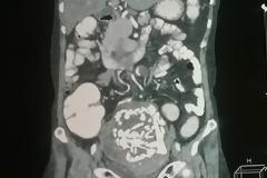 ΑΠΙΣΤΕΥΤΟ: Δείτε τι είχε στην κοιλιά της μία 60χρονη γυναίκα 36 χρόνια...[photo]