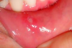 Άφτρες στο στόμα: Τι πρέπει να κάνετε και τι όχι