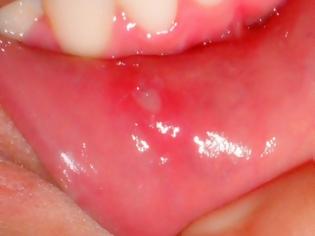 Φωτογραφία για Άφτρες στο στόμα: Τι πρέπει να κάνετε και τι όχι