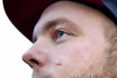 Για 17 μέρες είχε ένα κομμάτι μπουκαλιού καρφωμένο στο πρόσωπο - Ανατριχιαστική φωτογραφία