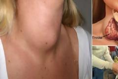 Οι γιατροί δεν θέλουν να το ξέρεις: Πώς να θεραπεύσεις τον θυρεοειδή αδένα σου με 1 μόνο συστατικό!