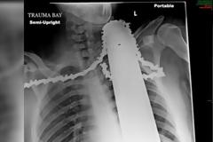 Απίστευτο: Το αλυσοπρίονο χώθηκε στον λαιμό του και... [photos]