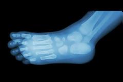 Άκανθα φτέρνας: Αιτίες και αντιμετώπιση