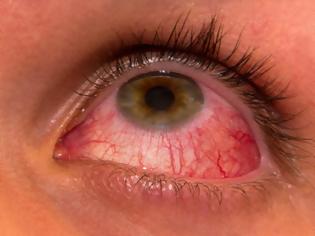 Φωτογραφία για Επιπεφυκίτιδα με τσίμπλα, δάκρυα, πρήξιμο και κόκκινα ερεθισμένα μάτια