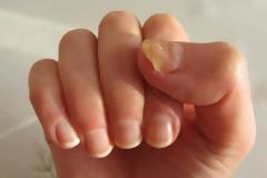 Προσοχή στις μυκητιάσεις στα νύχια - Πότε γίνονται επικίνδυνες