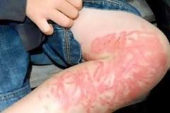 Νομίζετε ότι ξέρετε τι πρέπει να κάνετε αν σας τσιμπήσει τσούχτρα;