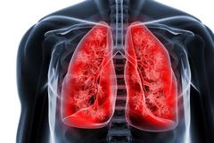 Καρκίνος του πνεύμονα: Έξι μύθοι και αλήθειες