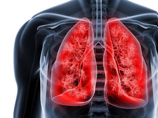 Φωτογραφία για Καρκίνος του πνεύμονα: Έξι μύθοι και αλήθειες