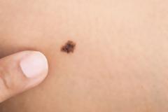 Ελιές στο δέρμα: Αυτά είναι τα 5 σημάδια που δείχνουν κίνδυνο για καρκίνο