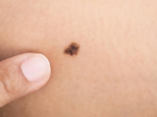 Φωτογραφία για Ελιές στο δέρμα: Αυτά είναι τα 5 σημάδια που δείχνουν κίνδυνο για καρκίνο