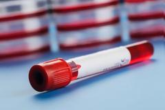 Ποια τα φυσιολογικά όρια του αιματοκρίτη σε κάθε ηλικία και πώς θα καταλάβετε ότι είναι κάτω από αυτά;