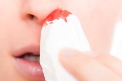 Αίμα από την μύτη: Τι πρέπει να κάνετε για να σταματήσει