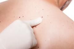 Ετσι θα εξαφανίστε τις κρεατοελιές από το δέρμα - Με κάτι που έχoυμε όλοι στο ντουλάπι... [video]