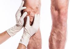 'Κλειδί' για τη σωστή διάγνωση των κιρσών ο απεικονιστικός έλεγχος με υπερήχους