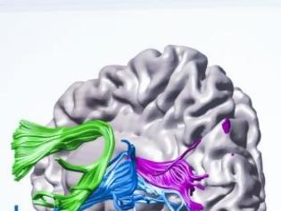 Φωτογραφία για Οι Δάσκαλοι είναι μηχανικοί του εγκεφάλου: H εντατική διδασκαλία αλλάζει τα εγκεφαλικά κυκλώματα σε αναγνώστες με προβλήματα