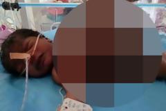 ΔΕΝ ΕΧΕΙ ΞΑΝΑΓΙΝΕΙ! Μωράκι γεννηθηκε με το νεκρό μισό δίδυμο αδερφάκι του να είναι μέσα στο σώμα του [photos]