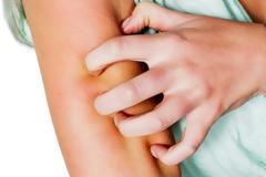 Τσιμπήματα κουνουπιών: Πώς μειώνεται γρήγορα το πρήξιμο και η φαγούρα