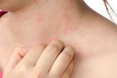 Παγκόσμια Ημέρα Αλλεργίας: Η αλλεργία αποτελεί τη μεγαλύτερη απειλή για το δέρμα μας