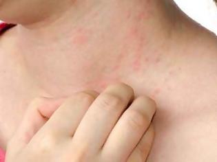 Φωτογραφία για Παγκόσμια Ημέρα Αλλεργίας: Η αλλεργία αποτελεί τη μεγαλύτερη απειλή για το δέρμα μας