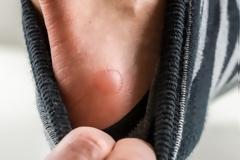 Τι να κάνετε για φουσκάλες, κάλους και σκληρύνσεις στα πόδια