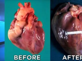Φωτογραφία για Πώς γίνεται η καρδιά μετά από μακροχρόνια χρήση κοκαΐνης