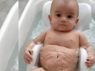 Φωτογραφία για Αγοράκι γεννήθηκε με τεράστια κοιλιά και 4 μέρες μετά η μητέρα του έμαθε τις τρομακτικές συνέπειες [video]