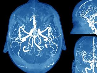 Φωτογραφία για Ανεύρυσμα εγκεφάλου: Τα συμπτώματα SOS που πρέπει να γνωρίζετε