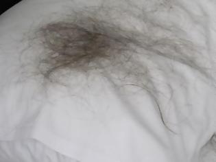 Φωτογραφία για «Μου έπεσαν όλα μου τα μαλλιά σε ένα βράδυ»