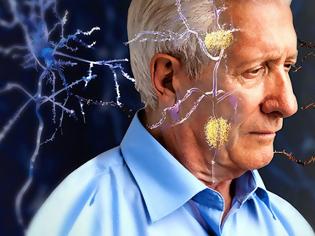Φωτογραφία για Φάρμακο για την ηπατική νόσο ενδεχομένως δρα θετικά έναντι του Αλτσχάιμερ, σύμφωνα με νέα μελέτη