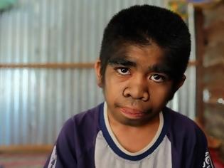 Φωτογραφία για ΣΟΚΑΡΙΣΤΙΚΟ: Ο 13χρονος λυκάνθρωπος που λατρεύεται σαν Θεός - Αρνείται οποιαδήποτε θεραπεία γιατί θεωρεί τον εαυτό του... [photos]