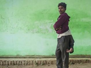 Φωτογραφία για Ο 22χρονος με τα τέσσερα πόδια ελπίζει σε μια φυσιολογική ζωή