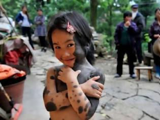 Φωτογραφία για Συγκλονιστική ιστορία: Το κοριτσάκι με το σύνδρομο του λύκου