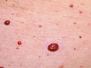 Φωτογραφία για Kόκκινες ελιές στο δέρμα (κερασοειδή αιμαγγειώματα). Είναι επικίνδυνες και πώς αντιμετωπίζονται;