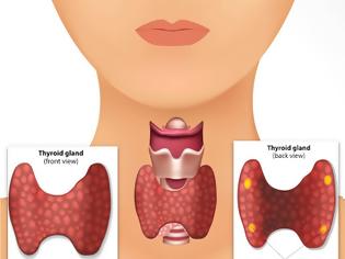 Φωτογραφία για Πίνακας με ερμηνεία εξετάσεων του θυρεοειδή αδένα. Υποθυρεοειδισμός, Υπερθυρεοειδισμός, Καρκίνος