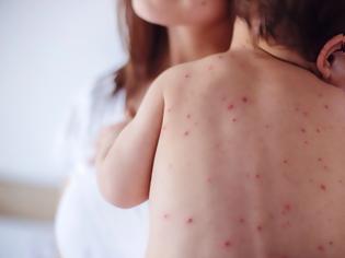 Φωτογραφία για Σε υψηλό 20ετίας τα κρούσματα ιλαράς στην Ευρώπη λόγω του αντιεμβολιαστικού κινήματος