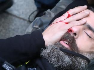 Φωτογραφία για Ηγετική μορφή των Κίτρινων Γιλέκων τραυματίστηκε σοβαρά στο μάτι κατά τη χθεσινή διαδήλωση