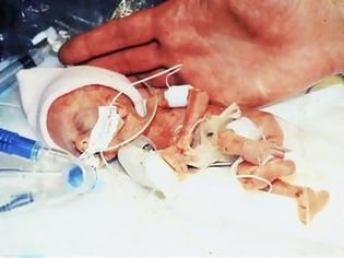 Φωτογραφία για Δείτε πώς είναι σήμερα το μικρότερο μωρό του κόσμου που ζύγιζε 280 γραμμάρια