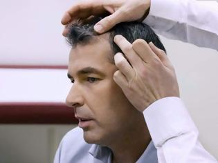 Φωτογραφία για Οι δερματολόγοι παγκοσμίως προειδοποιούν: Μην κάνετε μεταμοσχεύσεις μαλλιών στην Τουρκία