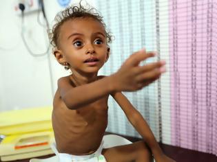 Φωτογραφία για Υεμένη: Χιλιάδες παιδιά πεθαίνουν, αλλά δεν είναι δικά μας