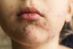 Επιδημία ιλαράς στις ΗΠΑ: Το χειρότερο ξέσπασμα εδώ και 20 χρόνια!