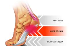 Πόνος στη φτέρνα,  άκανθα πτέρνας, πελματιαία απονεύρωση. Θεραπεία και ασκήσεις για το σπίτι