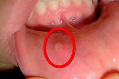 Άφθα, επώδυνη πληγή στο στόμα. Τι να κάνετε με τις άφθες;