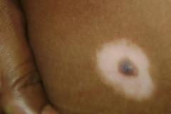 Τι είναι μια ελιά με λευκό στεφάνι; Σπίλος Sutton ή Halo. Έχει σχέση με λεύκη;