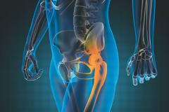 Νέα τεχνική στην αρθροπλαστική ισχίου